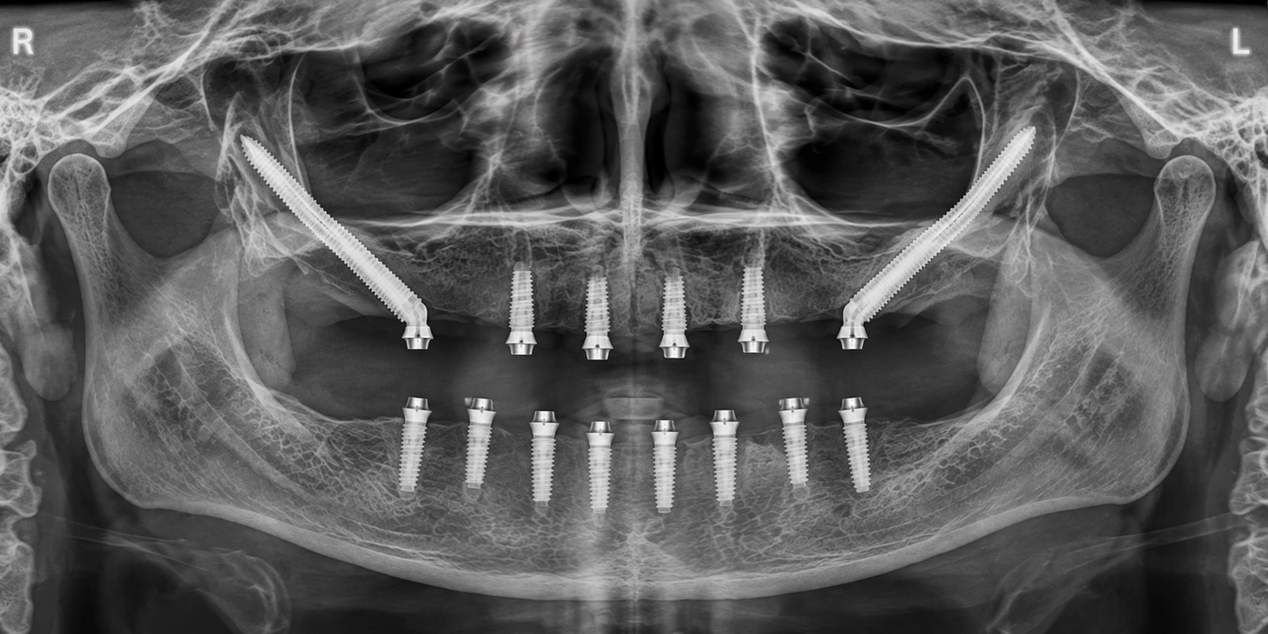 Representative panoramic radiograph for advanced maxillary implant rehabilitation